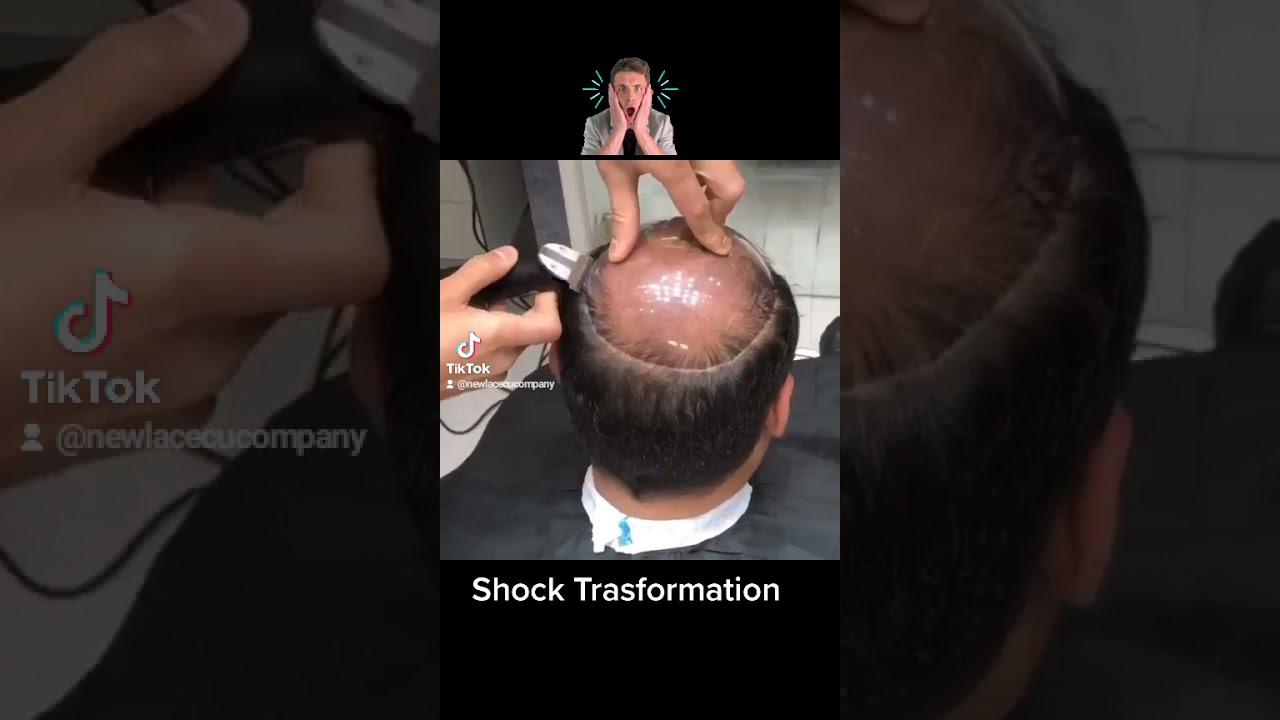 shock Man Trasformation 😱: Before After hair replacement system/ Protesi capelli uomo istallazione