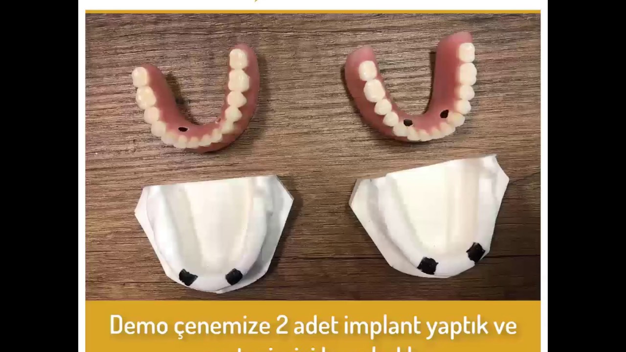 Değerli Hocamız Dr. Arda ÖZDİLER ile Bego Ball Attachment Hasta Ağzında Bağlama