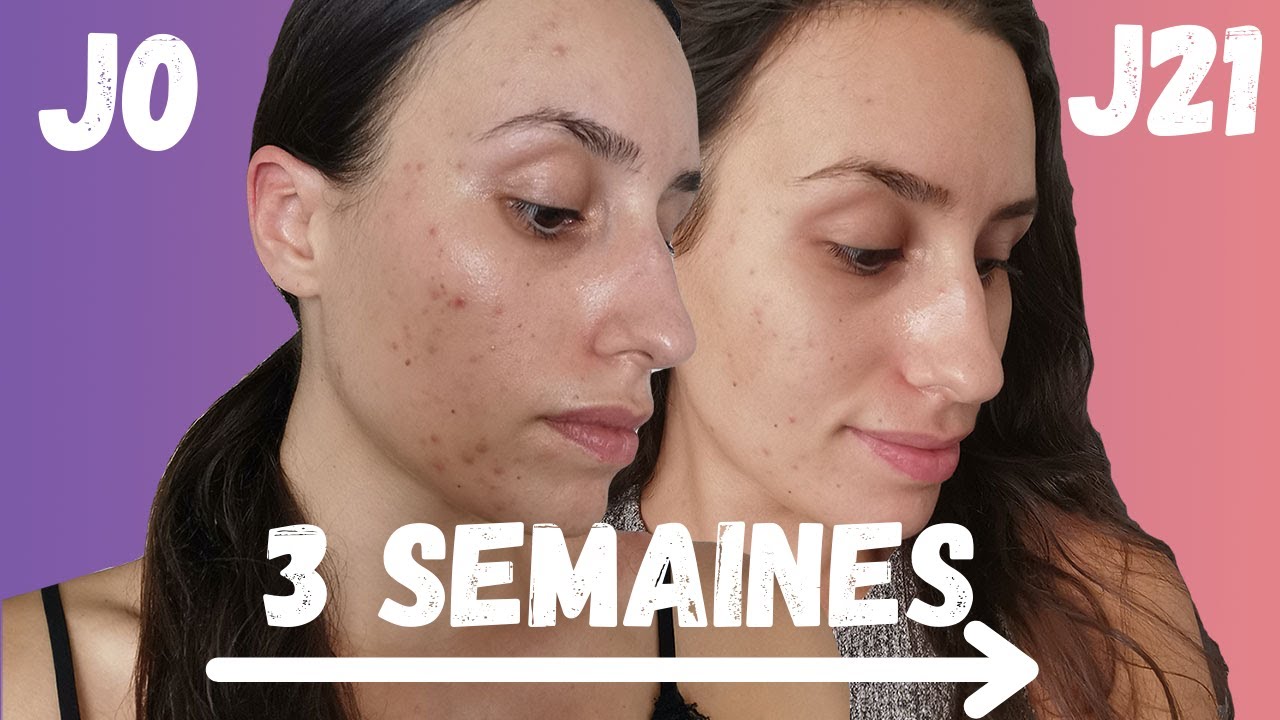 MA ROUTINE POUR DIMINUER LES CICATRICES D'ACNÉ ROUGES EN 3 SEMAINES (THE  ORDINARY, NIOD, PURITO...)