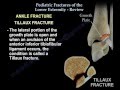 Pediatric Fractures Of The Lower Extremity Review - Everything You Need To Know - Dr. Nabil Ebraheim