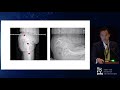 Spine Hip Pelvis Relationships  Spine Fusion & Hip Arhtroplasty   Brian Kwon, MD