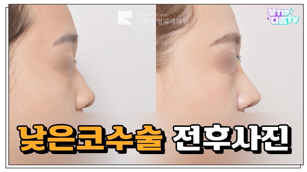 낮은코성형 전후사진 후기 ｜ 다름성형외과 ｜ Dareum Plastic Surgery - Youtube