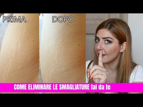 Video: Smagliature Sulla Pelle: Cosa Fare?