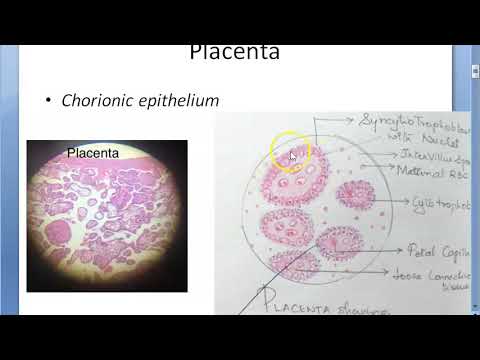 Obstetrics 243 GESTATIONAL TROPHOBLASTIC DISEASES Placental tumor Hydatidiform Mole Choriocarcinoma