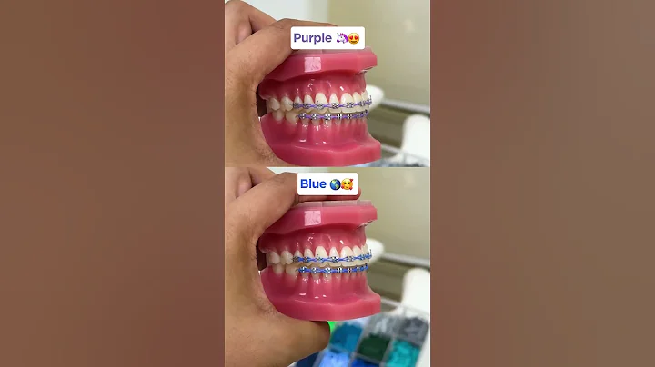 #Braces color that make your teeth look WHITER!