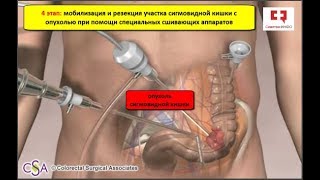 Рак толстой кишки: лечение рака операцией лапароскопическая резекция сигмовидной кишки