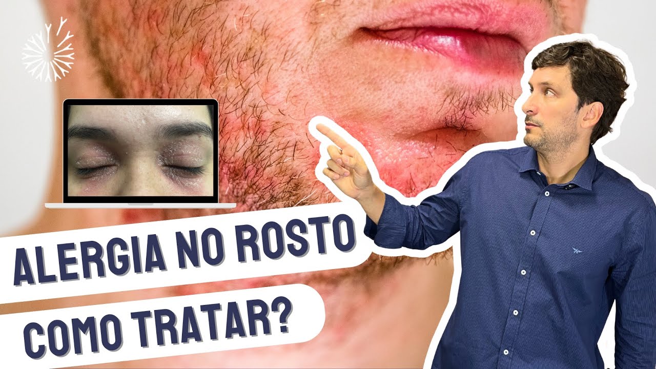 ALERGIA NO ROSTO - Alergista Explica como tratar #dermatite # ...