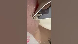blackhead removal from nose/ old aged blackheads removal