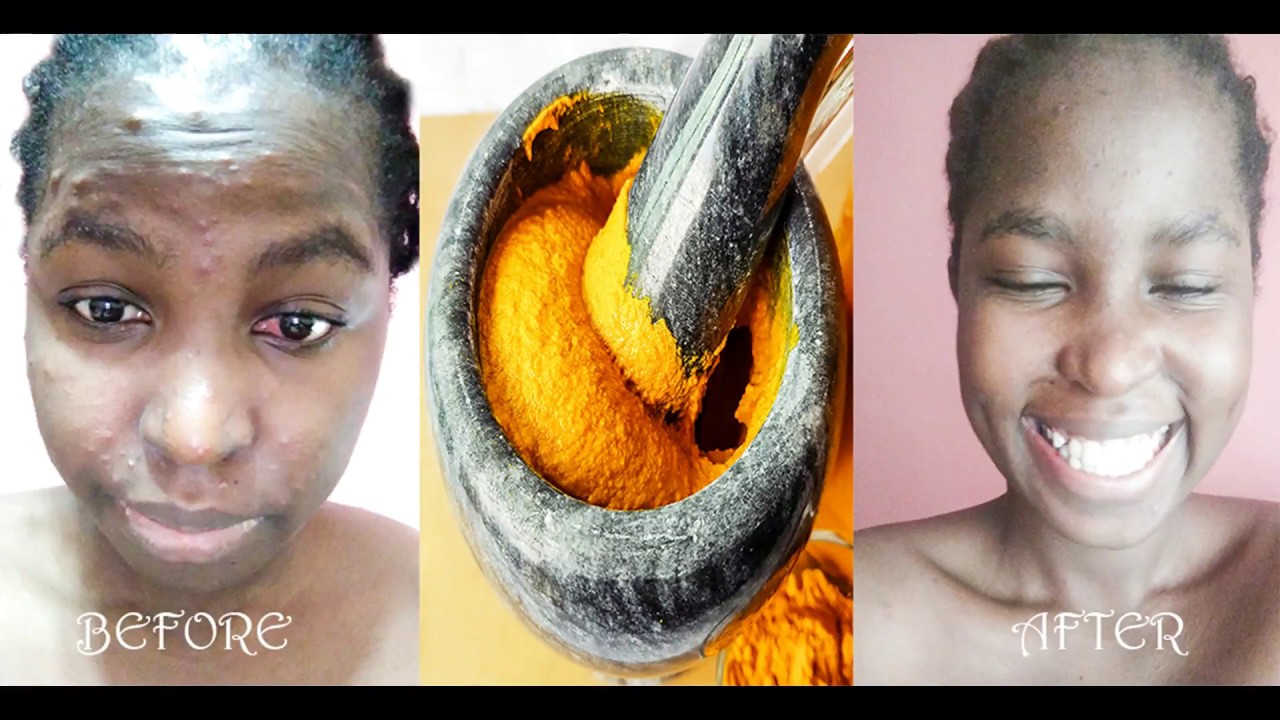 Skin Care Chicken pox Turmeric Home Remedies YouTube