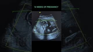 14 WEEKS of pregnancy ultrasound |fetus normal #shortsfeed #shorts #mother #motherhood #pregnancy