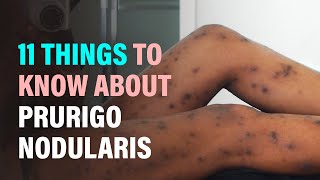 11 Things to Know About Prurigo Nodularis (Nodular Prurigo)