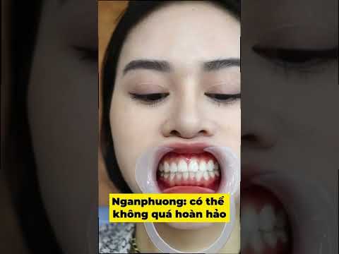 Video 'BỌC SỨ' không cần 'NIỀNG' phải có hàm răng đều cỡ... - youtube