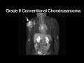 Grade ii conventional chondrosarcoma