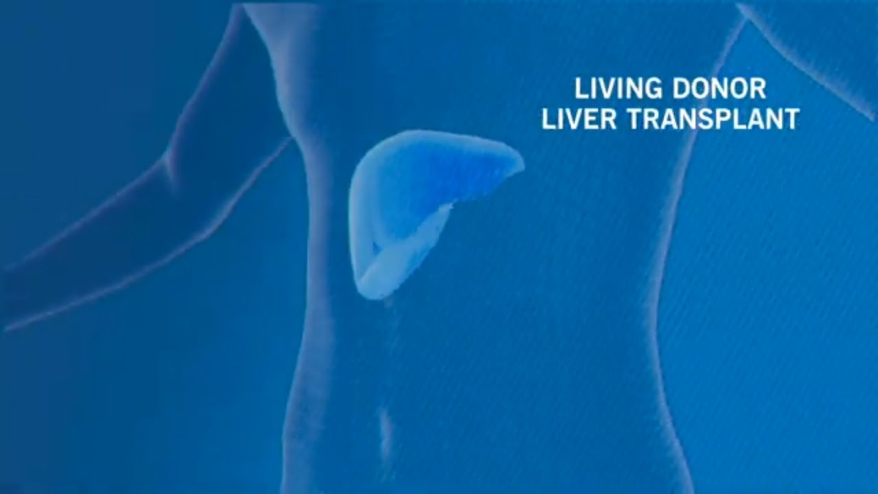 Living Donor Liver Transplant | Cleveland Clinic Florida - YouTube