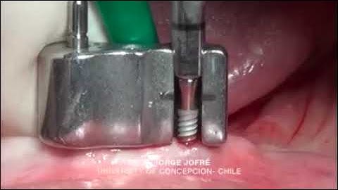 Easy2Fix Surgical Procedure By Prof. Jorge Jofre - Class II 14 September
