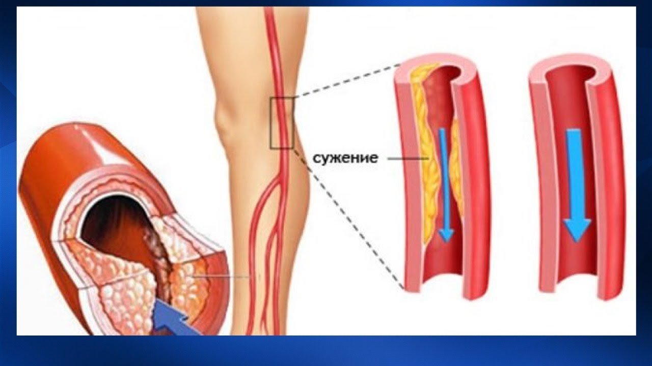Заболевания артерий вен. Облитерирующий атеросклероз сосудов конечностей. Облитерирующий атеросклероз сосудов ног. Облитерирующий атеросклероз периферических артерий. Облитерирующий атеросклероз сосудов нижней конечности 2,.