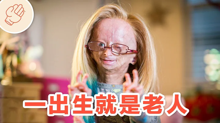 快速衰老的小女孩 - 天天要聞