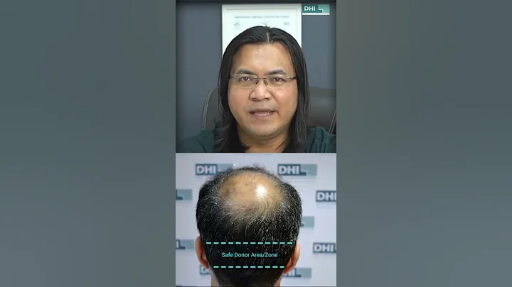 Why your transplanted hair will stay on your head? - DayDayNews