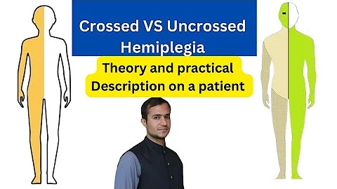 Crossed vs uncrossed hemiplegia #pediatrics #neurology