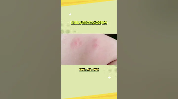 遼寧瀋陽發現一例猴痘病例，正隔離治療 - 天天要聞