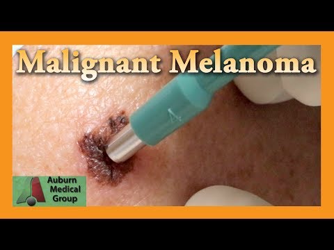 Vídeo: Melanoma De Pele - Melanoma Mole, Melanoma Pigmentado, Melanoma Facial