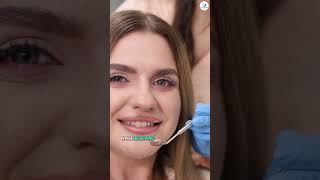 Expert Dental Veneers Available in Cuenca Ecuador #dentistry #ecuador