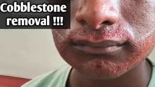 How to cure cobblestone after a beard transplant? | tamil |