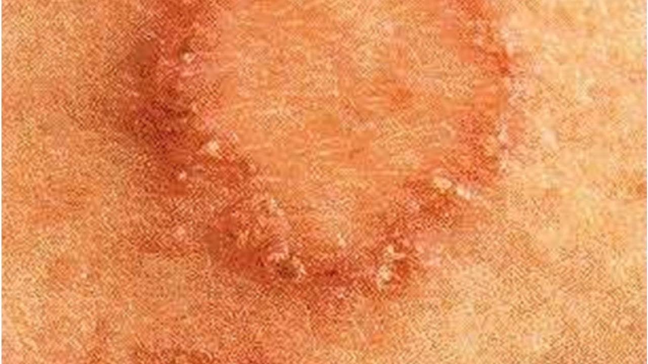Discoid Eczema: Its Symptoms, Causes and Remedies