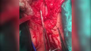 Sidik Kının Divertikulu - Dr Vahid İsmayılov