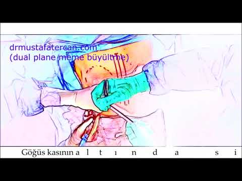 Meme Göğüs Büyültme Dual plane Prof  Dr  Mustafa Tercan