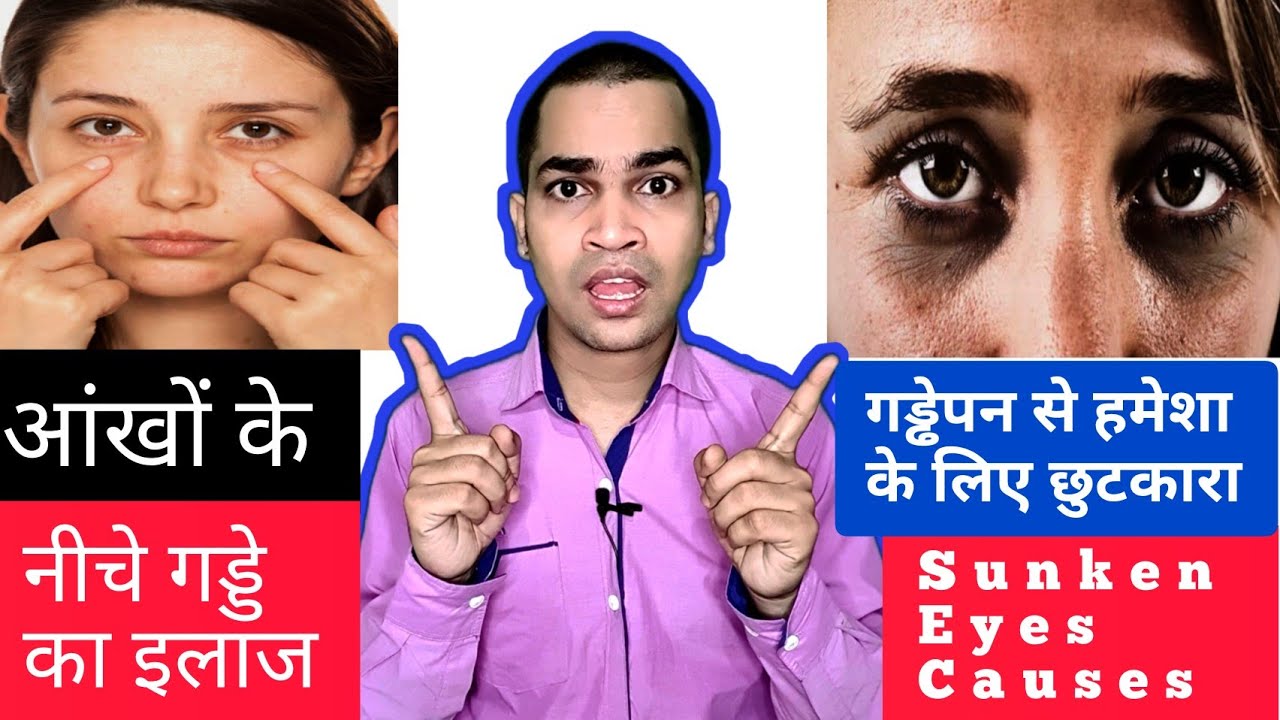 आंखों के नीचे गड्ढे - धंसी हुई आंखें- Dark circles & Wrinkles को 7 दिन में  || Sunken Eyes in Hindi - YouTube