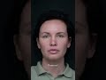 Везение не обязательно, всегда можно выполнить блефаропластику