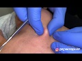 Satisfying Slow-Motion Cyst Explosion by Dr. Salar Hazany