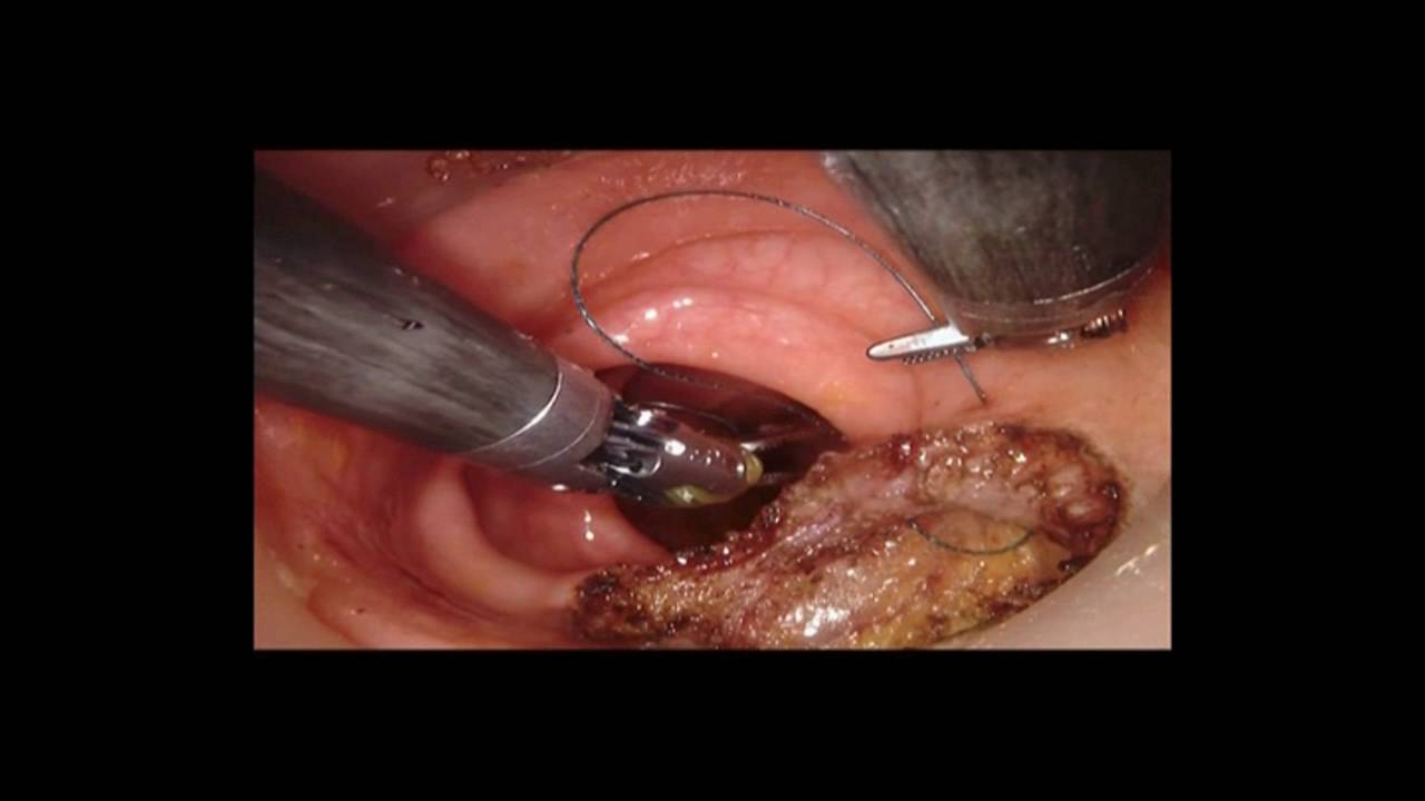 66. Robotic TAMIS da Vinci Xi system - by doctor Li-Jen Kuo (郭立人醫師