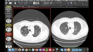 STR Cardiothoracic Case Webinar 3/28/2019