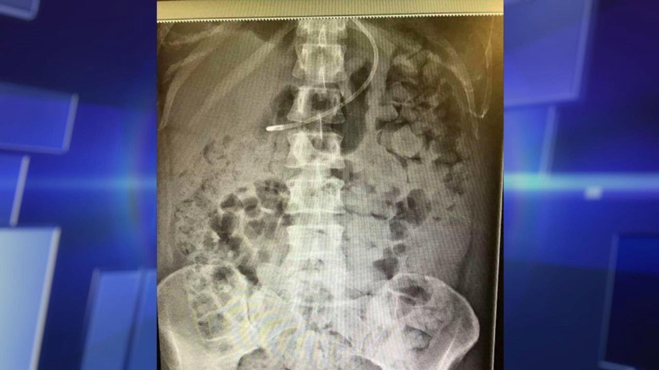 Woman Vomits Her Own Feces?