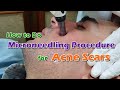 How to do microneedling proceduretreatmenttherapy with hyaluronic acid serum for acne scars  prp