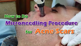 How to Do Microneedling Procedure/Treatment/Therapy with Hyaluronic Acid Serum for Acne Scars | PRP