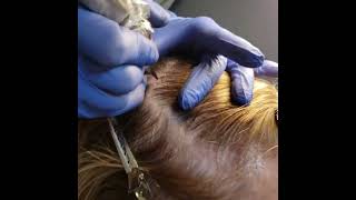 ✨ Natural Hair Density with Scalp Micropigmentation 💉