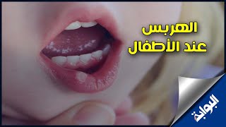 تعرف على أعراض الهربس عند الأطفال