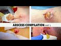 ABSCESS DRAINING COMPILATION (Part 1)