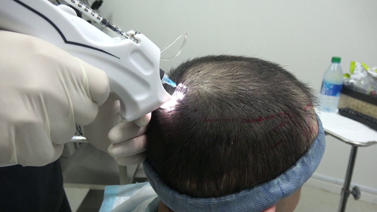 EXOSOMES: A HAIR RESTORATION TREATMENT WITH AWESOME POTENTIAL