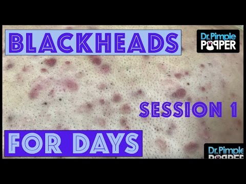 Blackheads For Dayzzzz With Dr Pimple Popper: Session 1