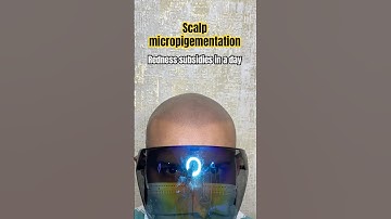 Best solution for hairloss with scalp micropigmentation #scalpmicropigmentation #smp #scalpdots