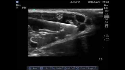 AXILLARY brachial block