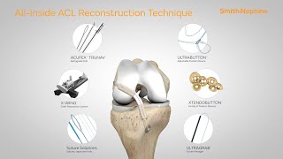 Allinside ACL Reconstruction Animation