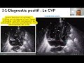 Cscwebinar 009  les shunt cardiaques gauchedroit