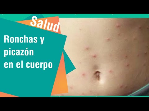 Vídeo: Sarpullido Y Piel Que Se Siente Caliente Al Tacto: Causas Y Fotos