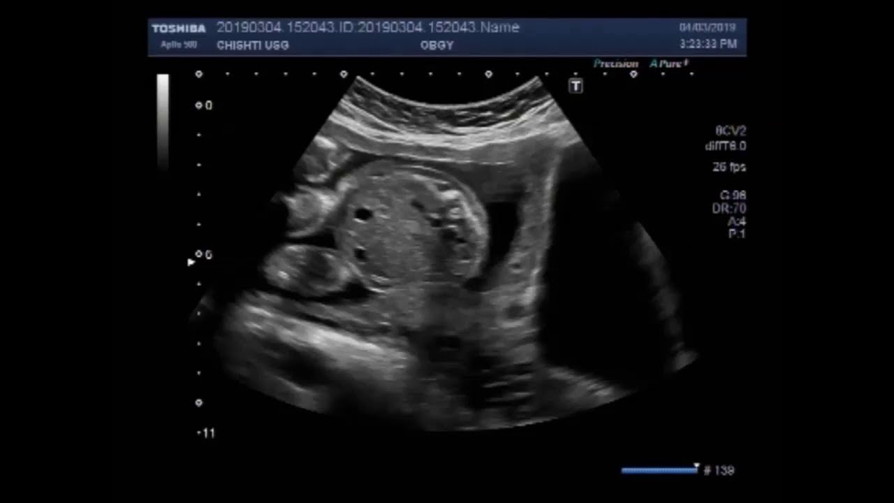 Ultrasound Video Showing Fetal Club Foot And Soft Tissue Edema Youtube