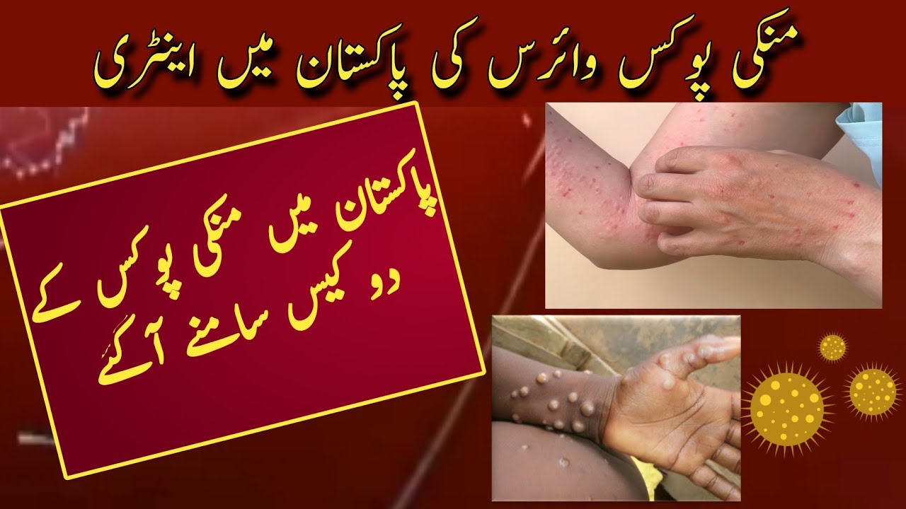 Monkeypox cases detected in Pakistan, special guidelines issued| Aqsa News 2.0